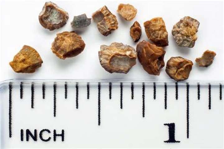 Can kidney stone cause bowel?