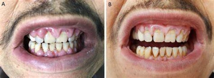 Does amlodipine cause gingival hyperplasia?