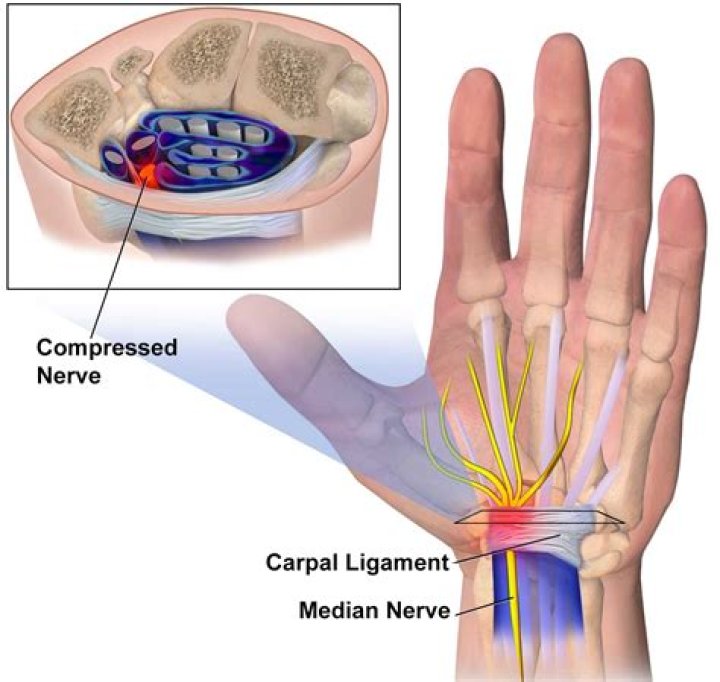 How carpal tunnel is diagnosed?