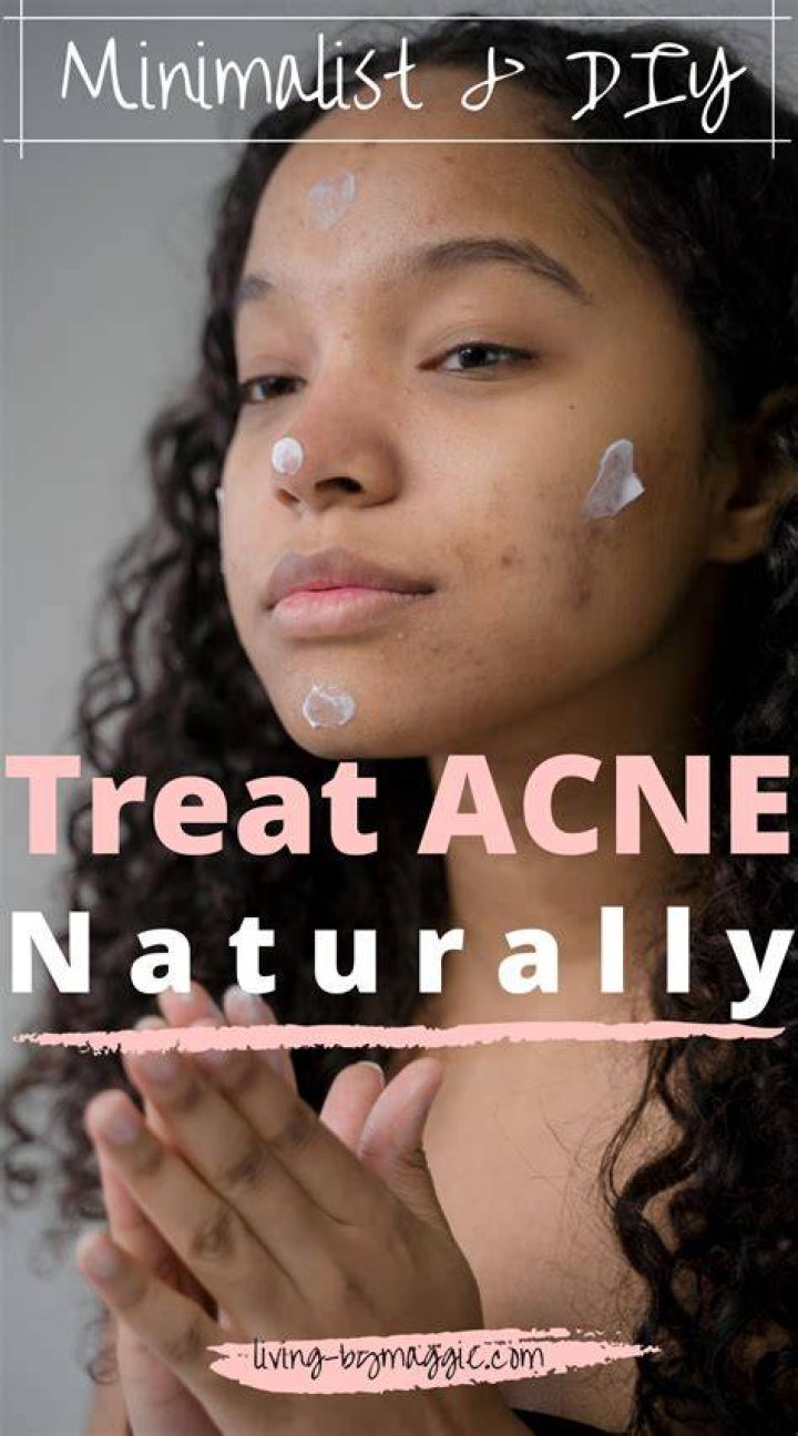 How to clear up your acne?
