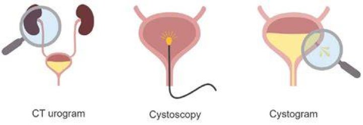 Is cystoscopy necessary after ct scan?