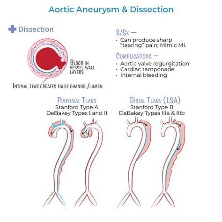 Is dissecting aortic aneurysm hereditary?