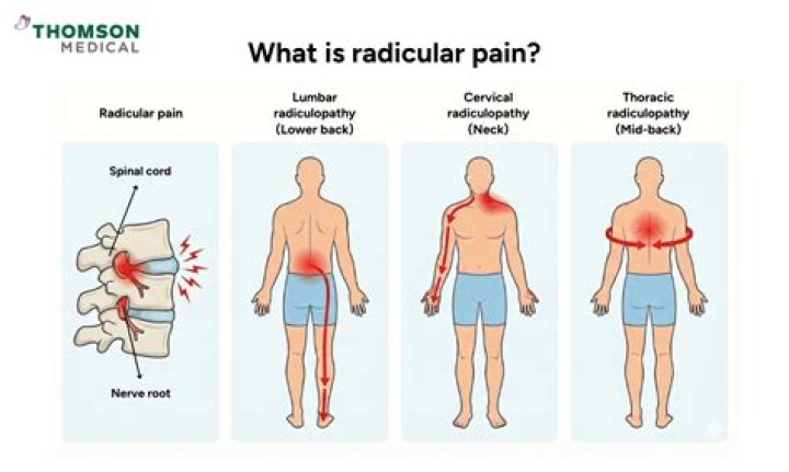 Is radicular a word?