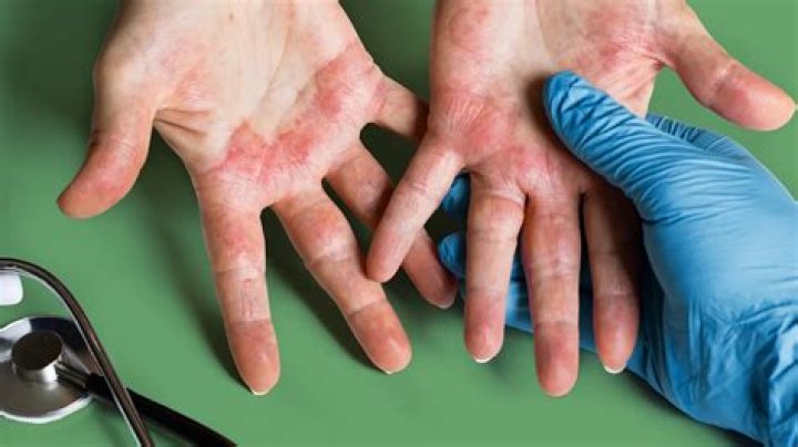Is scrotal eczema curable?