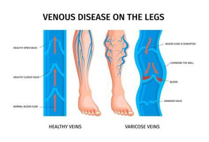What does venous blood mean?