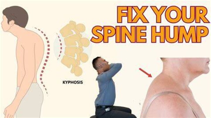 What is a hump on your back?