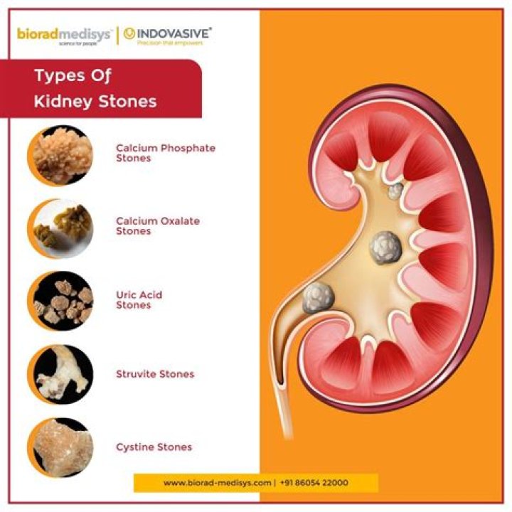 What is a silent kidney stone?