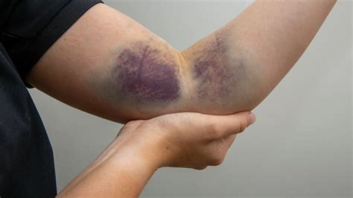 When to use contusion in a sentence?