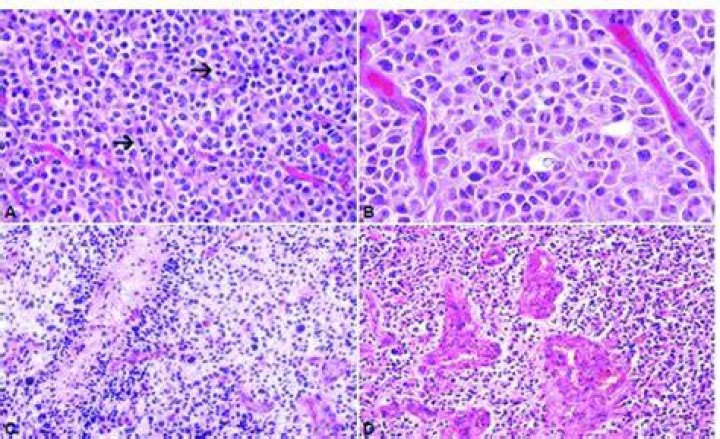 Where can oligodendroglioma be found?