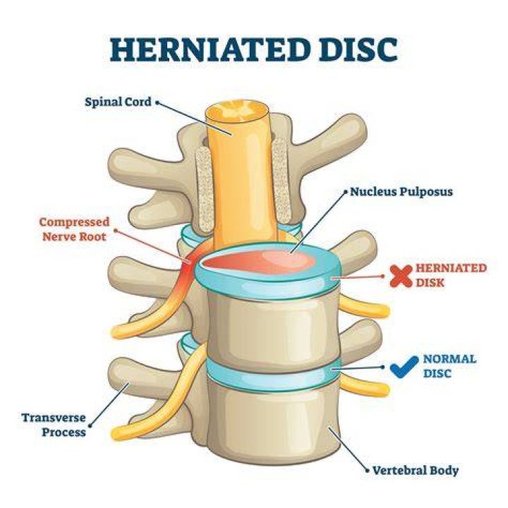 Who can diagnose ruptured disc?