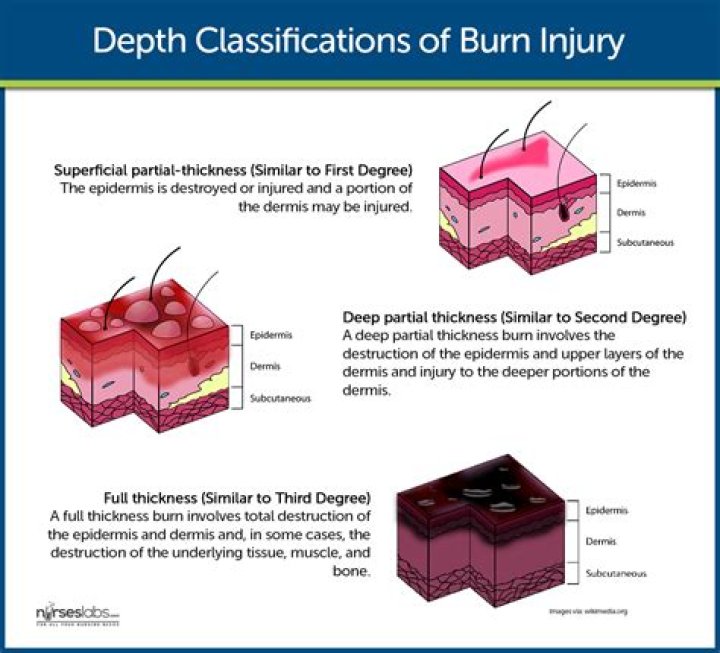 Who is superficial burn?
