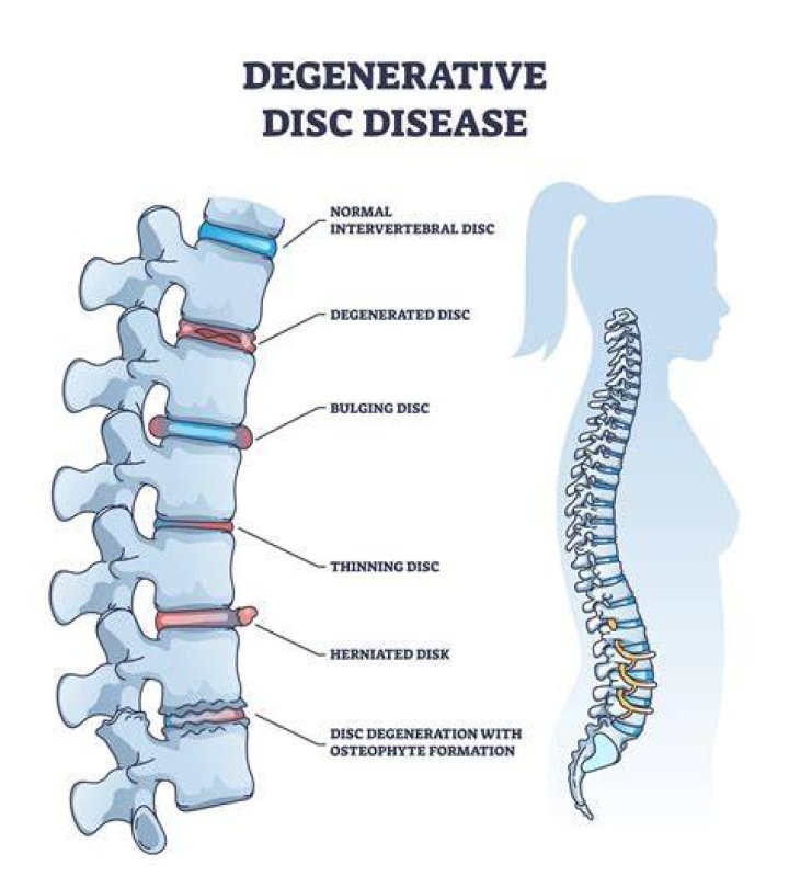 Why degenerative disc disease occurs?