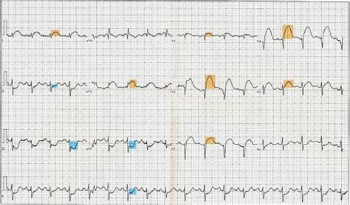 Will angina show on ecg?
